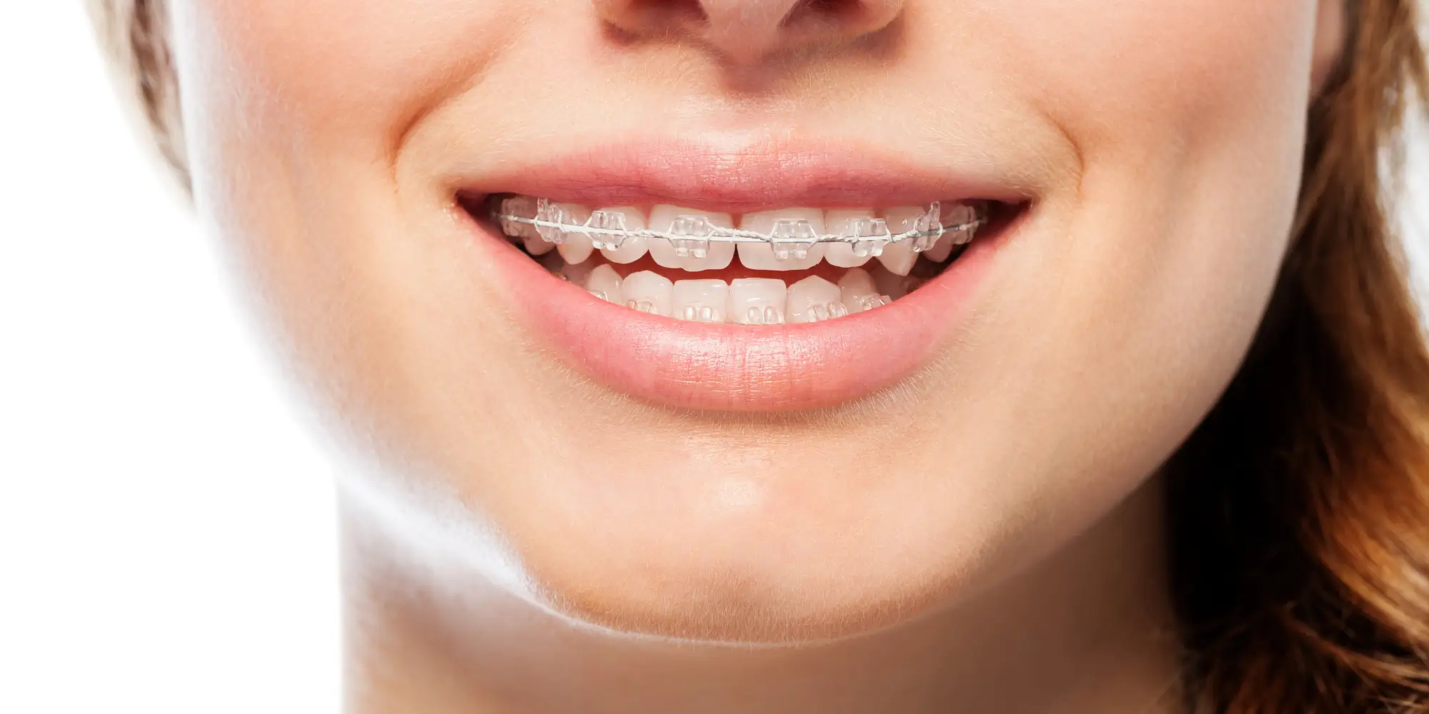 Keramikbrackets: