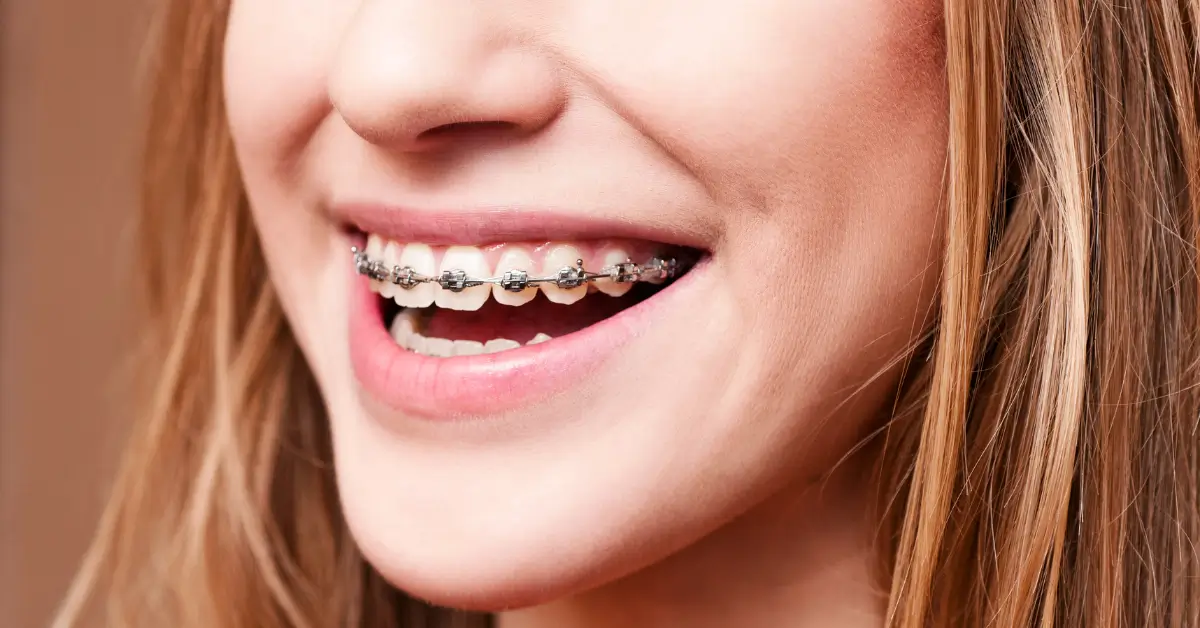Metallbrackets